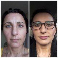 Botox Before And After Allergan (4)