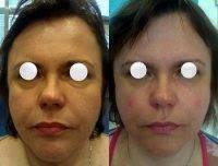 Botox Before And After Allergan (5)