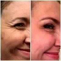 Botox Before And After Crows Feet Photo (2)