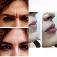 Botox Before And After Face (1)