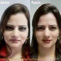 Botox Before And After Face (12)