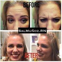 Botox Before And After Face (4)