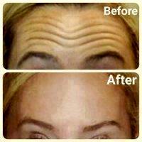 Botox Before And After Forehead (1)