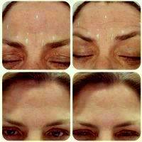 Botox Before And After Forehead (2)