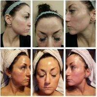 Botox Before And After Forehead (6)