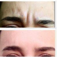 Botox Before And After Forehead (7)