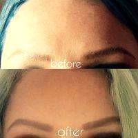 Botox Before And After Images (3)