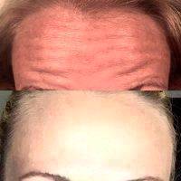 Botox Before And After Images (4)