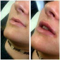 Botox Before And After Lip Injection