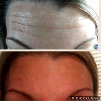 Botox Before And After Pics Forehead (10)