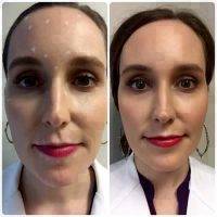 Botox Before And After Pics Forehead (12)