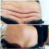 Botox Before And After Pics Forehead (2)