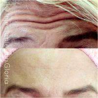 Botox Before And After Pics Forehead (4)