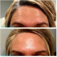 Botox Before And After Pics Forehead (5)
