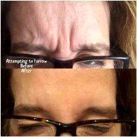 Botox Before And After Pics Forehead (9)