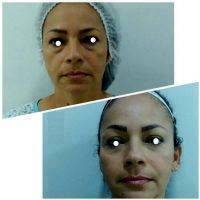 Botox Before And After Pictures (2)