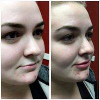 Botox Before And After Pictures (3)