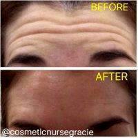 Botox Before And After Pictures Forehead (2)
