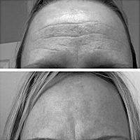 Botox Before And After Pictures Forehead (3)