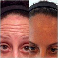 Botox Before And After Pictures Forehead (4)