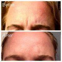 Botox Before And After Pictures Forehead (5)