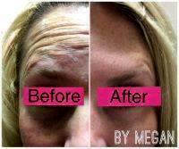 Botox Before And After Pictures Forehead (6)