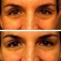 Botox Before And After Under Eyes