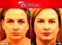 Botox Face Injections Before And After