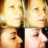 Botox Facelift Before And After Pictures (1)
