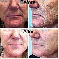 Botox Facelift Before And After Pictures (2)