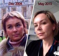 Botox Facelift Before And After Pictures (4)