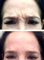 Botox Facelift Before And After Pictures (5)