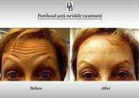 Botox Facelift Before And After Pictures (6)
