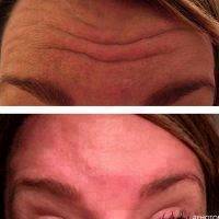 Botox Facelift Before And After Pictures (7)