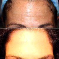 Botox Facelift Before And After Pictures (8)