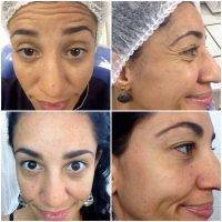 Botox Facelift Is A Skin Tightening Procedure Using Botox