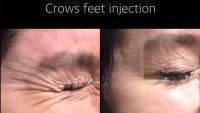 Botox For Crow's Feet Pictures Before And After