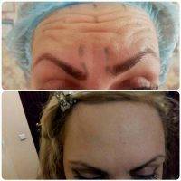 Botox Forehead Before And After Pics