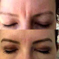 Botox Frown Lines Before And After Photos (1)