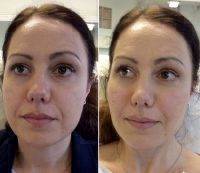 Botox Injections For Face