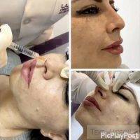Botox Is Injected Intradermally