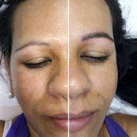 Botulinum Toxin For Face Before And After
