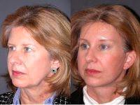 Deep Plane Facelift Before And After By Dr Jacono