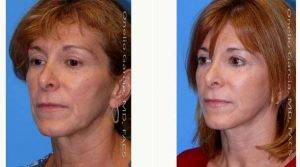 Doctor Onelio Garcia Jr, MD, FACS, Miami Plastic Surgeon - 42 Year Old Woman Treated With Facelift