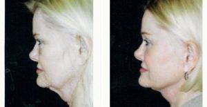 Doctor Robert H. Hunsaker, MD, Miami Plastic Surgeon - 49 Year Old Woman Treated With Facelift