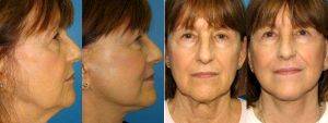 Doctor William LoVerme, MD, Boston Plastic Surgeon - Facelift And Necklift