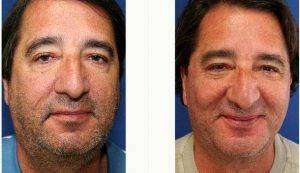 Doctor Zoran Potparic, MD, Fort Lauderdale Plastic Surgeon - 52 Year Old Man Treated With Facelift