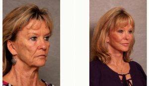 Dr Christian G. Drehsen, MD, Tampa Plastic Surgeon - Refresher Lift 61 Year Old Woman