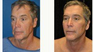 Dr Gary Motykie, MD, Los Angeles Plastic Surgeon - 60 Year Old Man Treated With Facelift