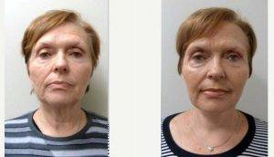 Dr Jeffrey H. Spiegel, MD, Boston Facial Plastic Surgeon - 60 Year Old Woman Treated With Facelift